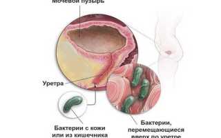 Что такое мвп в урологии
