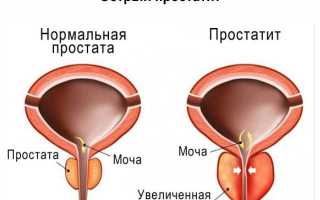 Самый лучший урологический массаж