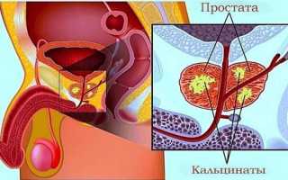 Что такое кальцинаты в предстательной железе