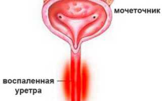 Уретрит: симптомы, причины, лечение
