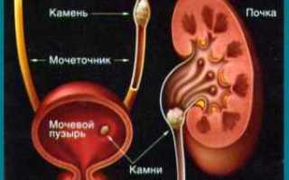 Мочекаменная болезнь симптомы и лечение у женщин