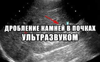 Стенд в почке после операции дробления