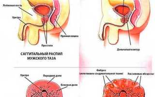 Лечение хронического простатита