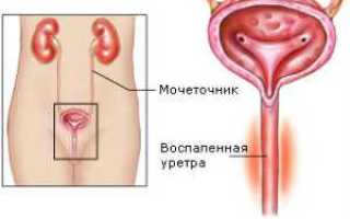 Воспаление ( уретрит ) мочевого канала у женщин