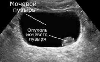 Доброкачественная опухоль мочевого пузыря у мужчин — Почки