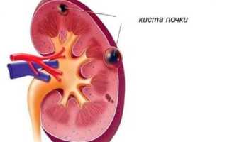 Киста в Почке: Причины (Признаки) Возникновения и Последствия