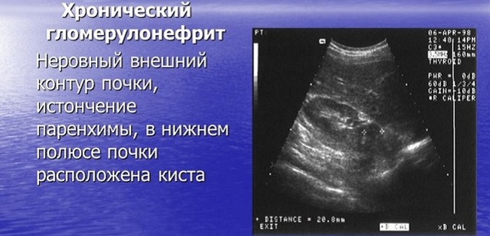хроническая почечная недостаточность