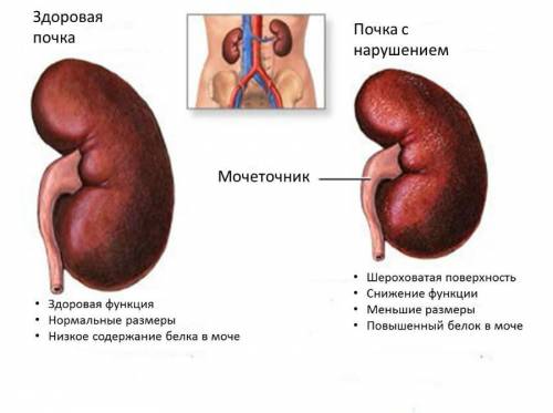 Здоровая и больная почка