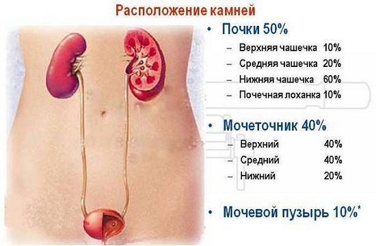  Расположение камней в мочевом пузыре и в почках: примерное соотношение по частоте локализации в конкретных областях 