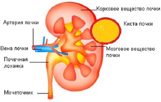  Расположение кисты почки и строение органа 