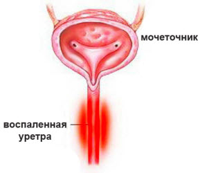Уретрит